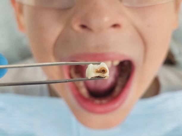 Best Emergency Dentist for Lost Fillings or Crowns in El Sobrante, CA